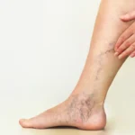 Varicose Veins