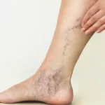 Spider veins
