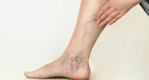 Spider veins