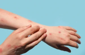MonkeyPox symptoms