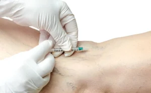Sclerotherapy male man Removal