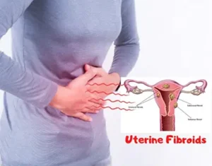Uterine Fibroids
