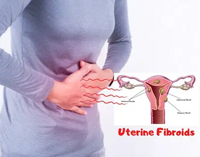 Uterine Fibroids