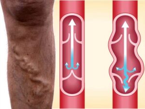 Managing Vein Issues During Pregnancy: Causes and the Removal Options