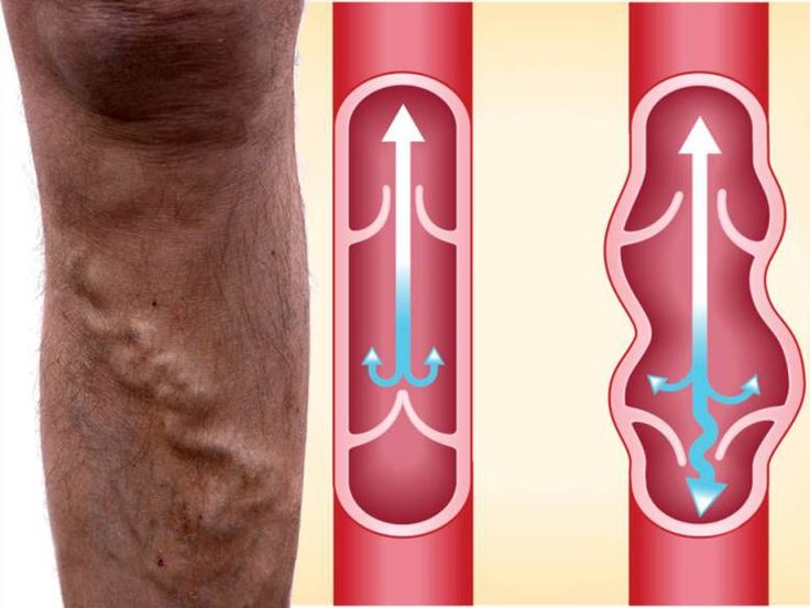 Managing Vein Issues During Pregnancy: Causes and the Removal Options