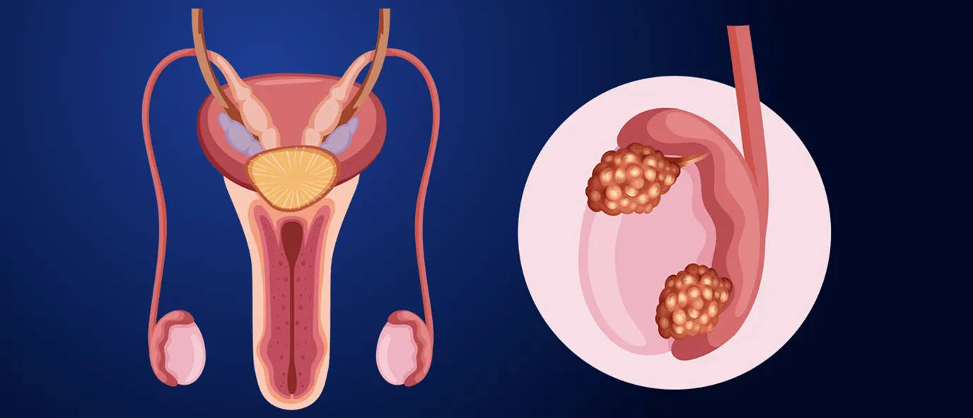How Modern Treatments Have Made Testicular Cancer One of the Most Curable Male Cancers