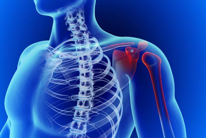 Benefits and Limitations of Arthroscopic Surgery for Rotator Cuff Tears