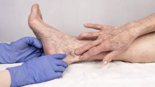 Sclerotherapy vs Laser Treatment: Which Is Better for Spider Veins?