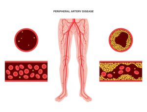 Can You Reverse Peripheral Artery Disease Naturally? What the Experts Say
