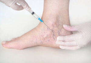 Big Apple Medical Care’s Advanced Approach to Vascular Surgery