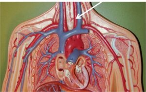 Subclavian Artery Disease: When Blood Flow to the Arms Is Compromised