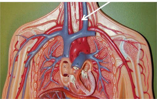Subclavian Artery Disease: When Blood Flow to the Arms Is Compromised