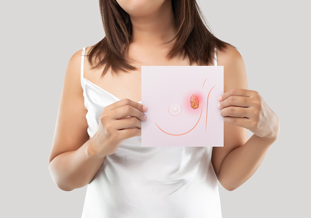 Galactocele and Other Breast Cysts During Lactation: Recognizing Serious Breastfeeding Complications